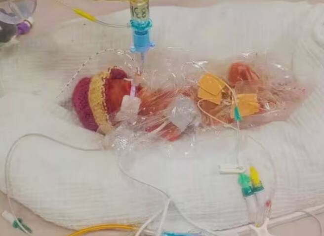 smallest child uk wales smallest baby robyn chambers weighing 328 grams while born 4 महिन्यांच्या गरोदरपणानंतर दिला मुलीला जन्म; वजन फक्त 328 ग्रॅम, पालक चिंतेत