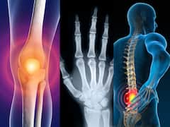 Osteoarthritis Rheumatoid Arthritis Spine Injuries Differentiate