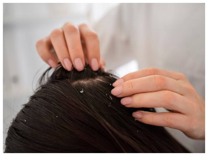 Dandruff problem started with increasing cold Adopt these methods to prevent hair fall ठंड बढ़ने के साथ शुरू हो गई डैंड्रफ की समस्या? बाल झड़ने से रोकने के लिए अपनाएं ये तरीके