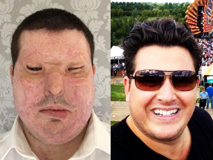 Acid Attack Survivor Andreas Christopheros Told His Sad Story After 60 Life Saving Surgeries 