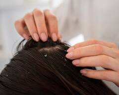 Dandruff treatment at home: ਸਿੱਕਰੀ ਦੀ ਸਮੱਸਿਆ ਤੋਂ ਪ੍ਰੇਸ਼ਾਨ...ਤਾਂ ਦੂਰ ਕਰਨ ਲਈ ਅਪਨਾਓ ਇਹ ਆਸਾਨ ਘਰੇਲੂ ਨੁਸਖੇ