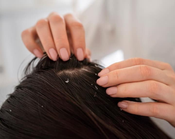 ਸਰਦੀਆਂ ਦੀਆਂ ਖੁਸ਼ਕ ਅਤੇ ਠੰਡੀਆਂ ਹਵਾਵਾਂ ਕਾਰਨ ਸਿਰ ਦੀ ਚਮੜੀ ਆਪਣੀ ਨਮੀ ਗੁਆ ਦਿੰਦੀ ਹੈ, ਜਿਸ ਕਾਰਨ ਵਾਲਾਂ ਵਿੱਚ ਡੈਂਡਰਫ ਦੀ ਸਮੱਸਿਆ ਵੱਧ ਜਾਂਦੀ ਹੈ। ਇਸ ਤੋਂ ਇਲਾਵਾ ਸਰਦੀਆਂ ਵਿੱਚ ਗਰਮ ਪਾਣੀ ਨਾਲ ਵਾਲ ਧੋਣ ਦੀ ਆਦਤ ਵੀ ਡੈਂਡਰਫ ਨੂੰ ਵਧਾਉਂਦੀ ਹੈ ਕਿਉਂਕਿ ਗਰਮ ਪਾਣੀ ਸਿਰ ਦੀ ਨਮੀ ਅਤੇ ਤੇਲ ਨੂੰ ਦੂਰ ਕਰਦਾ ਹੈ। ਅਜਿਹੀ ਸਥਿਤੀ ਵਿੱਚ ਵਾਲਾਂ ਦੀ ਚਮਕ ਖਤਮ ਹੋ ਜਾਂਦੀ ਹੈ ਅਤੇ ਵਾਲਾਂ ਦਾ ਝੜਨਾ ਵੱਧ ਜਾਂਦਾ ਹੈ।