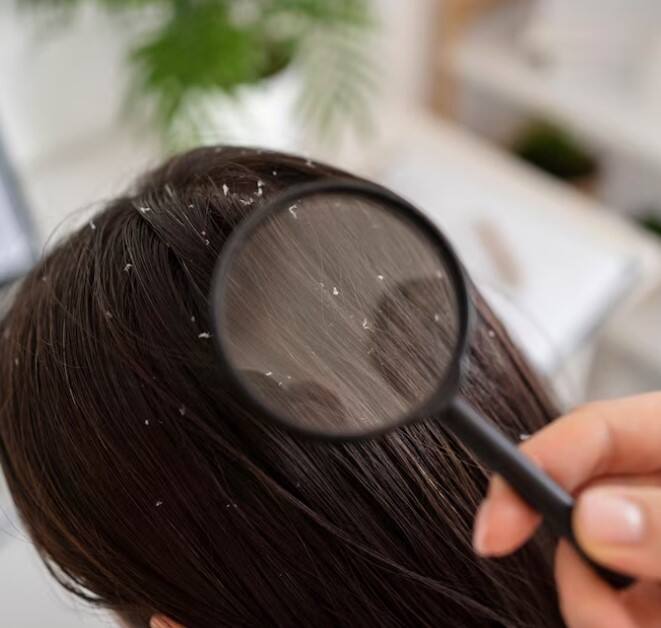 ਇਸ ਨੂੰ ਵਾਲਾਂ 'ਤੇ ਲਗਾਉਣ ਨਾਲ ਇਹ ਵਾਲਾਂ ਨੂੰ ਹਾਈਡ੍ਰੇਟ ਰੱਖਦਾ ਹੈ ਅਤੇ ਡੈਂਡਰਫ ਨੂੰ ਰੋਕਦਾ ਹੈ। ਇਹ ਡੈਂਡਰਫ ਤੋਂ ਛੁਟਕਾਰਾ ਪਾਉਣ ਲਈ ਇੱਕ ਕੁਦਰਤੀ ਅਤੇ ਪ੍ਰਭਾਵਸ਼ਾਲੀ ਉਪਾਅ ਹੈ।