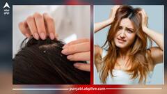 Dandruff treatment at home: ਸਿੱਕਰੀ ਦੀ ਸਮੱਸਿਆ ਤੋਂ ਪ੍ਰੇਸ਼ਾਨ...ਤਾਂ ਦੂਰ ਕਰਨ ਲਈ ਅਪਨਾਓ ਇਹ ਆਸਾਨ ਘਰੇਲੂ ਨੁਸਖੇ