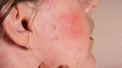 'या' कारणामुळे थंडीत तुमचे गाल लाल होतात; त्वचेला हायड्रेट ठेवण्यासाठी सोप्या टिप्स फॉलो करा