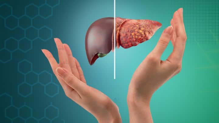 If you feel these symptoms in the body, be careful, it is a sign of infection in the liver | Health: શરીરમાં આ લક્ષણો અનુભવાય તો સાવધાન, લીવરમાં ઇન્ફેકશનના છે સંકેત