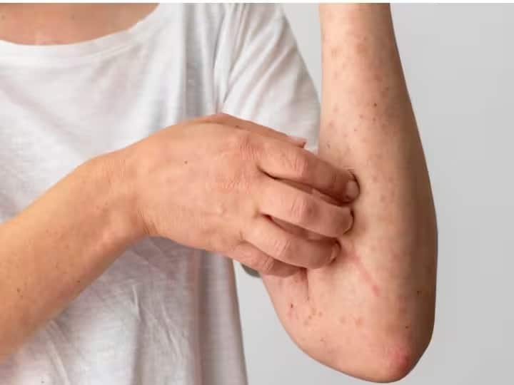 Health Tips skin problems can be a sign of seriousness of diabetes marathi news Health Tips : 'या' त्वचेच्या समस्या मधुमेहाच्या गंभीरतेचे लक्षण; वेळीच काळजी घ्या, अन्यथा...