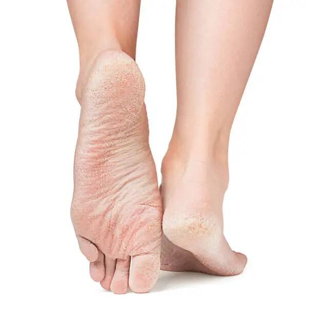 তাছাড়াও অনেকের পায়ের গোড়ালি ফেটে যায়। তবে একটু সচেতনতা আর একটু বাড়তি যত্ন নিলে সারা বছরই কিন্তু আপনার পা কোমল ও সুন্দর থাকবে।