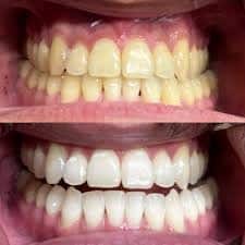 महागड्या टूथपेस्ट सुद्धा 'या' 5 आयुर्वेदिक उपायांसमोर फिक्या; पिवळे दात पांढरे करण्यासाठी खास टिप्स...