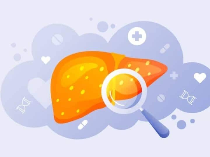 Nonalcoholic fatty liver disease Symptoms and causes marathi news update Fatty Liver Disease : नॉन-अल्कोहोलिक फॅटी लिव्हरची लक्षणे कोणती? त्यापासून बचाव कसा कराल?