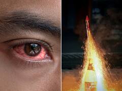 Eye Injuries Due To Diwali Firecrackers: Check Dos And Don'ts
