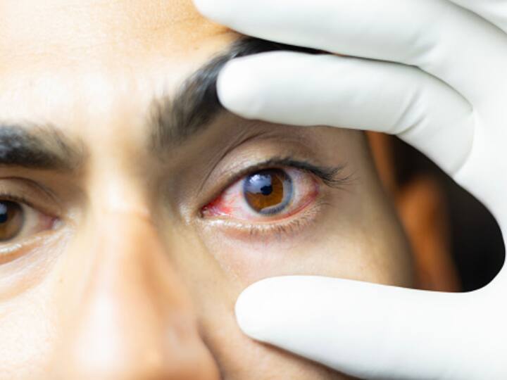Any attempt to blow air into the wounded eye can exacerbate the damage. And no attempt should be made to remove any embedded foreign objects. This can cause further harm | Photo: Getty
