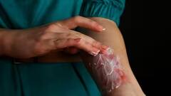 Diwali 2023: ફટાકડા ફોડતા દાઝી જવાય તો અપનાવો આ 7 ઘરેલુ ઉપાય, બળતરાથી તરત જ મળશે રાહત