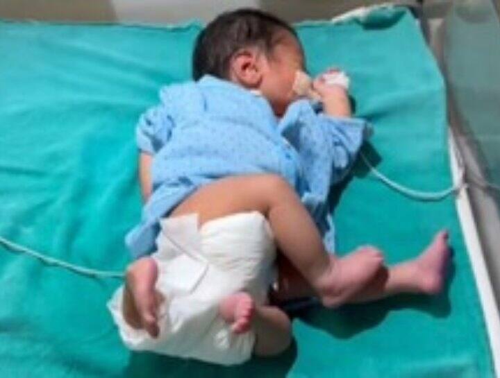 Muzaffarnagar child with 4 arms and 4 legs born treatment going on in Meerut medical college UP News: चार हाथ, चार पैर, दो गुप्तांग... यूपी में जन्मे 'चमत्कारी बच्चे' को देख हर कोई हैरान, जानें- अब कैसी है हालत