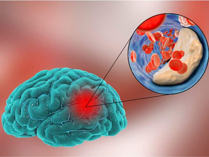 Stroke Is Fourth Leading Cause Of Death In India Global Cases Projected To Increase By 50 Per Cent By 2050 Experts ABPP Stroke Is Fourth Leading Cause Of Death In India, Global Cases Projected To Increase By 50 Per Cent By 2050