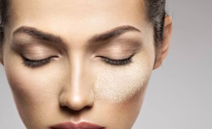 চিকিৎসকের পরামর্শ মতো চললে অনেক সময় উপকার মেলে যদিও। তার বাইরে ঘরোয়া কিছু টোটকায় মিলতে পারে উপকার।