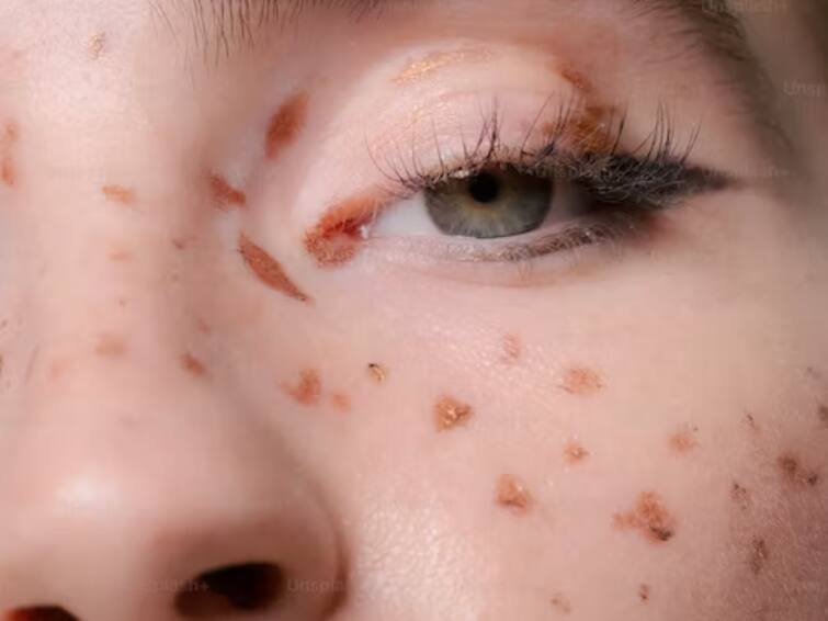 Say Goodbye To Acne  3-Ingredient Drink For Glowing Skin Acne Free Skin: முகப்பரு பிரச்சனையா? இந்த ஒரு பானம் போதும் - சருமம் க்ளீயர் ஆகிடும்