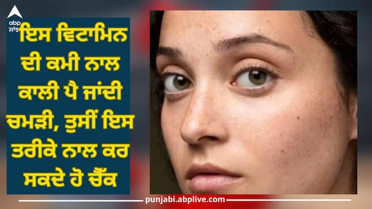 skin color starts darkening due to deficiency of this vitamin trending health news Skin color starts darkening: ਇਸ ਵਿਟਾਮਿਨ ਦੀ ਕਮੀ ਨਾਲ ਕਾਲੀ ਪੈ ਜਾਂਦੀ ਚਮੜੀ, ਤੁਸੀਂ ਇਸ ਤਰੀਕੇ ਨਾਲ ਕਰ ਸਕਦੇ ਹੋ ਚੈੱਕ