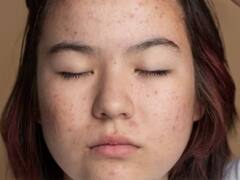 Health Tips: इस विटामिन की कमी से काला पड़ने लगता है त्वचा का रंग