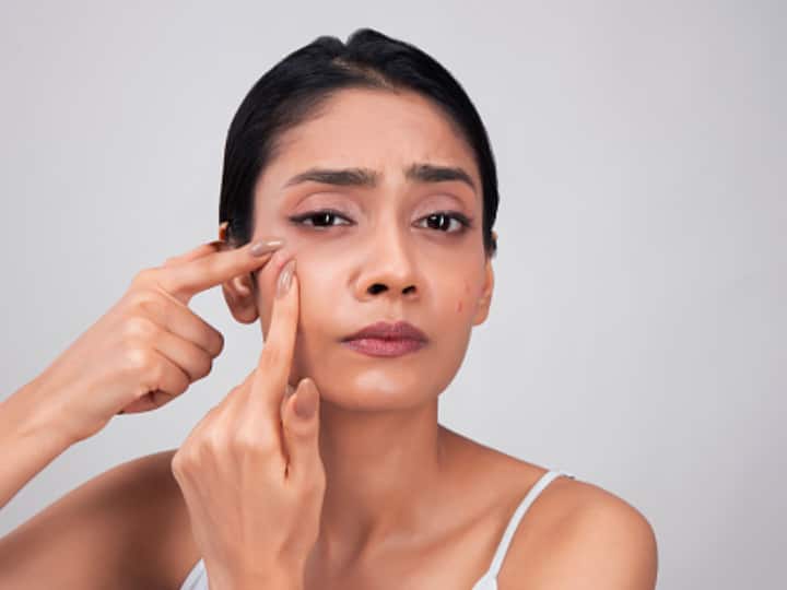 Easy Home Remedies To Cure Acne Do You suffer From Acne Problems? Know These Home Remedies Shared By Experts