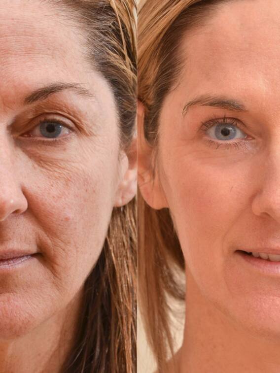 झुर्रियों का इलाज हैं ये घरेलू चीजें