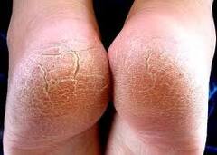 भेगा पडलेल्या टाचांचा आरोग्याशी नेमका संबंध काय? वाचा तज्ज्ञांचं मत