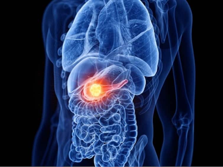 Pancreatic Cancer Warning Signs Silent Threat Pancreatic Cancer: Warning Signs, And Why It Is A Silent Threat