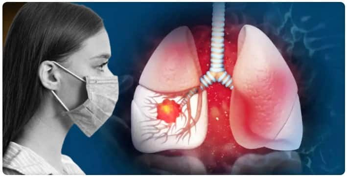 what is White Lung Syndrome Lung Syndrome: ਕੀ ਤੁਹਾਨੂੰ ਪਤਾ ਇਸ ਸਿੰਡਰੋਮ ਨੇ ਦੁਨੀਆਂ ਨੂੰ ਸੋਚਣ ਲਈ ਕਿਉਂ ਕੀਤਾ ਮਜ਼ਬੂਰ ? ਲੱਛਣ ਜਾਣ ਕੇ ਤੁਸੀਂ ਹੋ ਜਾਵੋਗੇ ਹੈਰਾਨ 