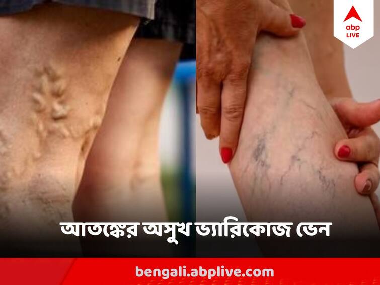 Varicose veins Increasing In India, Modern Treatment Started In Kolkata, Know Varicose veins symptoms treatment ABP Live Exclusive abpp Varicose veins : পায়ের চামড়ার নিচে নীলাভ ছাপ? জট পাকানো শিরা? কঠিন পরিণতি নিয়ে আসতে পারে ভ্যারিকোজ ভেন
