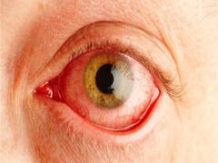 PHOTO: 'हे' आहेत डोळ्यांचे गंभीर विकार...