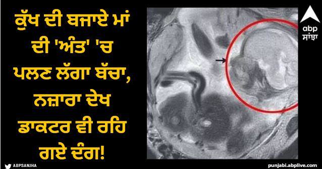 baby grows inside mothers bowel doctor gets shock after discovering it Viral News: ਕੁੱਖ ਦੀ ਬਜਾਏ ਮਾਂ ਦੀ 'ਅੰਤ' 'ਚ ਪਲਣ ਲੱਗਾ ਬੱਚਾ, ਔਰਤ ਨੂੰ ਹੋਇਆ ਦਰਦ, ਨਜ਼ਾਰਾ ਦੇਖ ਡਾਕਟਰ ਵੀ ਰਹਿ ਗਏ ਦੰਗ!