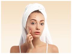 चेहरे में इस विटामिन्स की कमी के कारण निकलते हैं बहुत दाने, जानें यहां