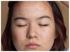 Skin Care Tips : वारंवार चेहऱ्यावर येणाऱ्या पिंपल्सने हैराण आहात? शरीरात 'या' व्हिटॅमिन्सची कमतरता