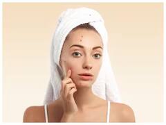 Skin Care Tips : वारंवार चेहऱ्यावर येणाऱ्या पिंपल्सने हैराण आहात? शरीरात 'या' व्हिटॅमिन्सची कमतरता