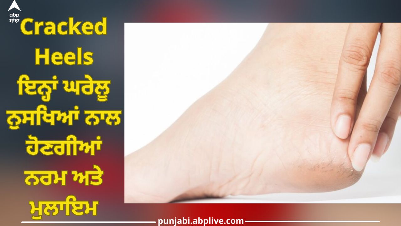 Diy Dry Cracked Heels Remedy (Salve) | Cracked heel remedies, Homemade foot  cream, Cracked heel remedies diy