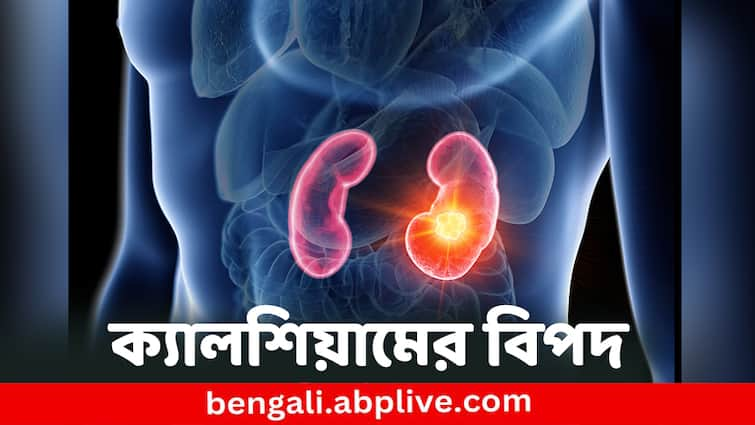 Calcium Supplement can cause kidney stones, know all details Calcium Supplement: প্রেসক্রিপশন ছাড়াই ক্যালসিয়াম সাপ্লিমেন্ট খাচ্ছেন ? ঠিক করছেন না ভুল করছেন