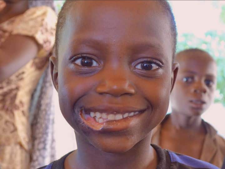 क्या है नोमा, जिसे WHO ने एनटीडी बीमारियों की लिस्ट में किया शामिल? इस रोग का भारत पर क्या हो सकता है असर