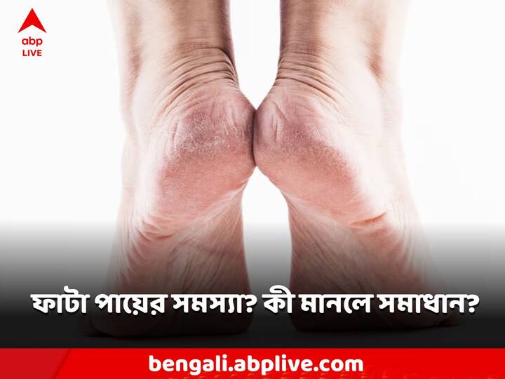 Cracked Feet: শীত পড়তেই ফাটছে গোড়ালি? এই টোটকা মানলেই কেল্লাফতে