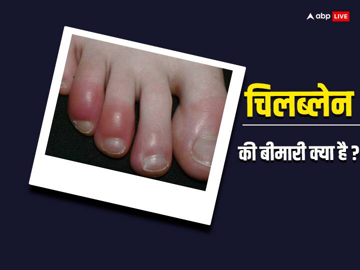 Chilblains: सर्दी में आपकी स्किन पर भी होती है खुजली? इसके पीछे हैं ये गंभीर कारण blisters itchiness Chilblains typically show up within 1 day of your exposure to the cold Chilblains: सर्दी में आपकी स्किन पर भी होती है खुजली? इसके पीछे हैं ये गंभीर कारण