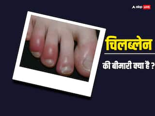 Chilblains: सर्दी में आपकी स्किन पर भी होती है खुजली? इसके पीछे हैं ये गंभीर कारण