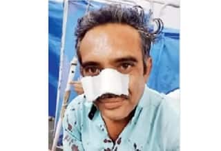 Surat News: In Surat, a bike riders nose, cheek and throat were cut by a kite thread Surat: કાતિલ દોરીનો કહેર શરૂ, સુરતમાં પતંગના દોરાથી બાઇક ચાલકનું નાક, ગાલ અને ગળાનો ભાગ ચીરાયો