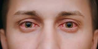 Health Tips :हिवाळ्यात डोळे सतत लाल होत असतील तर जाणून घ्या तज्ज्ञांकडून उपाय; लगेच आराम मिळेल