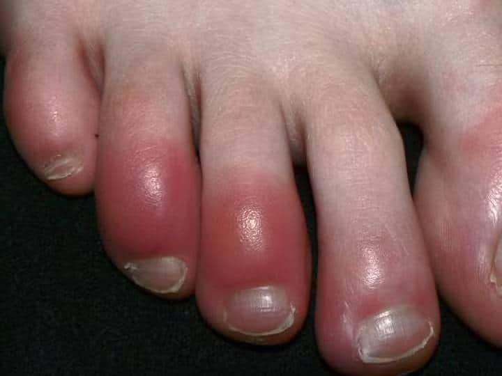 Avoid rapid change in temperature It is not cold that cause chilblains