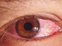 सर्दियों में हो रही है आपकी भी आंखें लाल तो कर लें ये उपाय