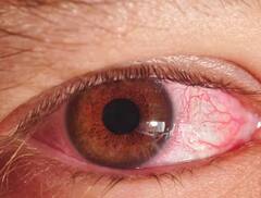 Red eyes: ਸਰਦੀਆਂ ‘ਚ ਅੱਖਾਂ ਹੋ ਰਹੀਆਂ ਲਾਲ, ਤਾਂ ਕਰ ਲਓ ਇਹ ਕੰਮ, ਤੁਰੰਤ ਆਵੇਗਾ ਆਰਾਮ