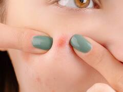 Skin Care : चेहऱ्यावरील पिंपल्स घालवायचे आहेत? आहारातील 'या' घटकांकडे लक्ष द्या