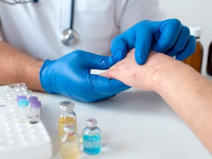 Cases Of Monkeypox Reported In Israel Symptoms and Preventive Measures Of The Viral Infection इज़राइल में तेजी से बढ़ रहे हैं मंकीपॉक्स के केसेस, जानिए इसके लक्षण और बचाव का तरीका