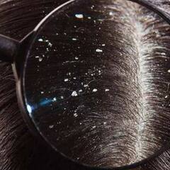 Hair Care: ਸਰਦੀਆਂ ਚ ਕੀ ਤੁਹਾਡੇ ਵੀ ਹੁੰਦੀ ਹੈ ਵਾਰ ਵਾਰ ਸਿੱਕਰੀ?