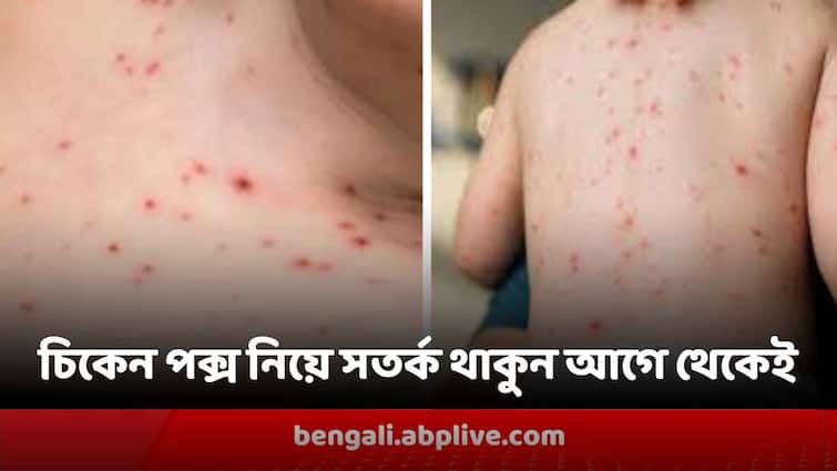 Chicken Pox May Be Dangerous For elderly people, know the symptoms