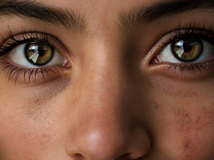 इसमें पानी आंखों के चारों तरफ घूमता रहता है. साथ ही लगातार आंखों से पानी निकलता रहता है. जिसके कारण आंखों पर जोड़ पड़ता है. और दिखाई देने की शक्ति धुंधली होने लगती है. ग्लूकोमा के इस टाइप में ट्रबेक्युलर नर्व में दिक्कत आने लगती है.यह एक जेनेटिक कारण बन सकता है. यह बीमारी प्रेग्नेंसी के दौरान भी हो सकता है.